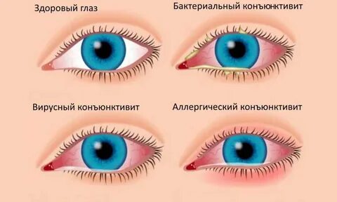 Конъюнктивит сколько дней