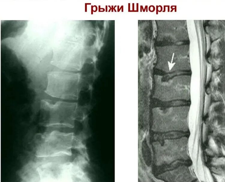 Протрузии шморля. Грыжи шморля в поясничном отделе позвоночника рентген.