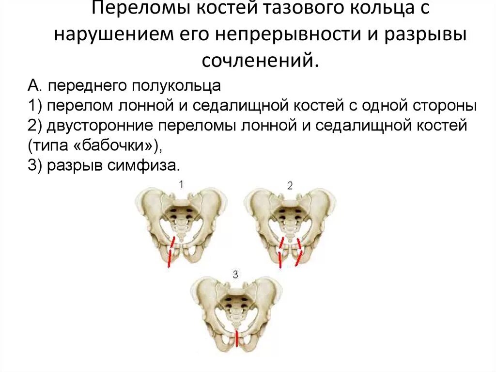 Переломы костей таза с нарушением непрерывности тазового кольца. Перелом костей таза с нарушением тазового кольца. Переломы с нарушением непрерывности тазового кольца. Переломы костей тазового кольца без нарушения его непрерывности.