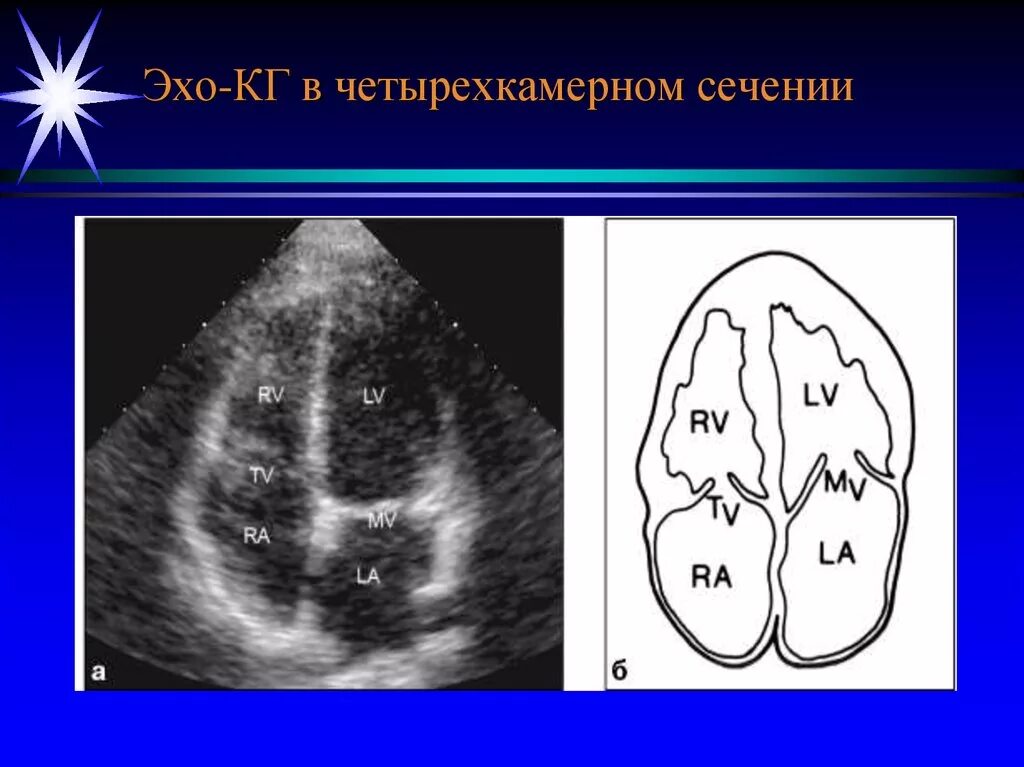 Эхокардиография 4 камерное сечение. Четырехкамерная позиция в ЭХОКГ. Лучевая диагностика ССС системы. Четырехкамерное сечение на эхокардиографии. Четырехкамерный срез сердца