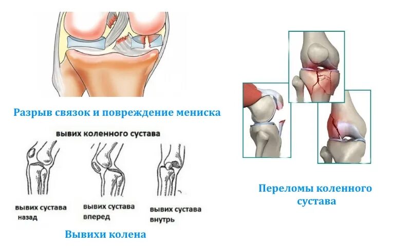 Типы разрывов мениска. Смещение коленного сустава. Внутренняя сторона колена.