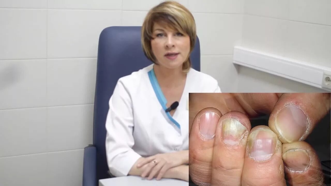 Лечение грибка ногтя врач. Подногтевой онихомикоз. Грибковые инфекции ногтей онихомикозы.