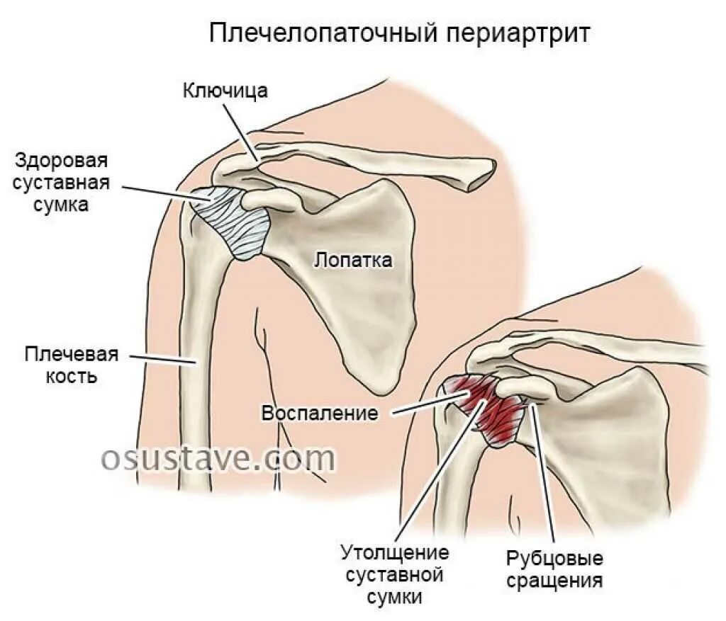 Сильная боль в области плечевого сустава. Периартрит плечевого сустава синдром. Синдром плечелопаточный периартрит. Плече-лопаточная периартрит. Адгезивный капсулит плеча.