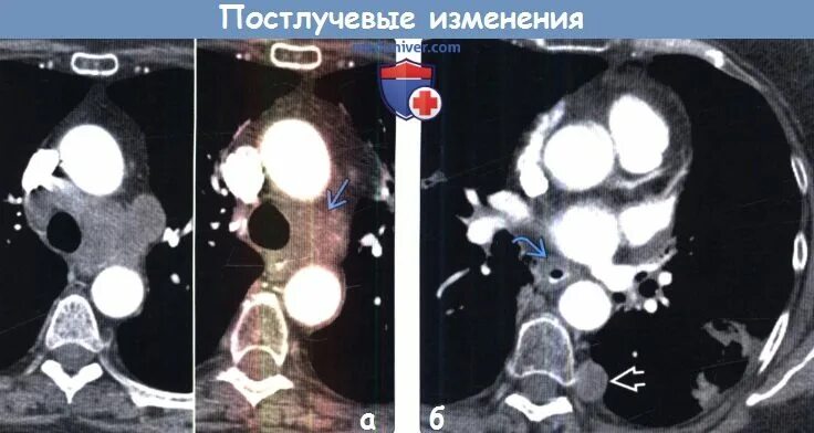 Постлучевые изменения в легких на кт. Кт легких после лучевой терапии. Постлучевой пневмонит на кт.