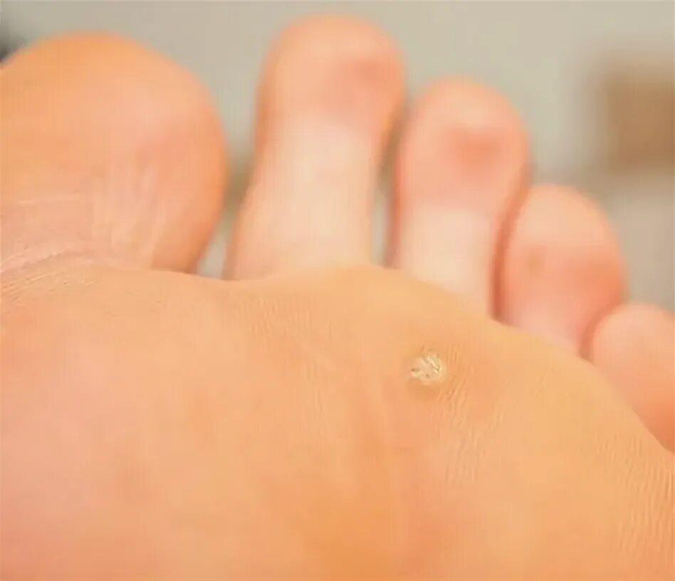 Plantar Warts - Ottawa Foot Clinic
