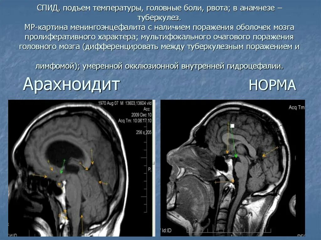 Мозговой туберкулез