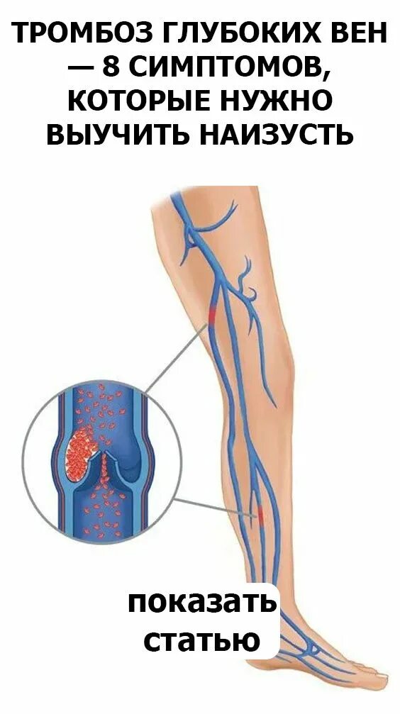 Тромбоз поверхностных вен голени. Флеботромбоз глубоких вен нижних конечностей симптомы. Тромбофлебит поверхностных вен голени. Тромбоз глубоких вен нижних конечностей схема. Как снизить тромбоз
