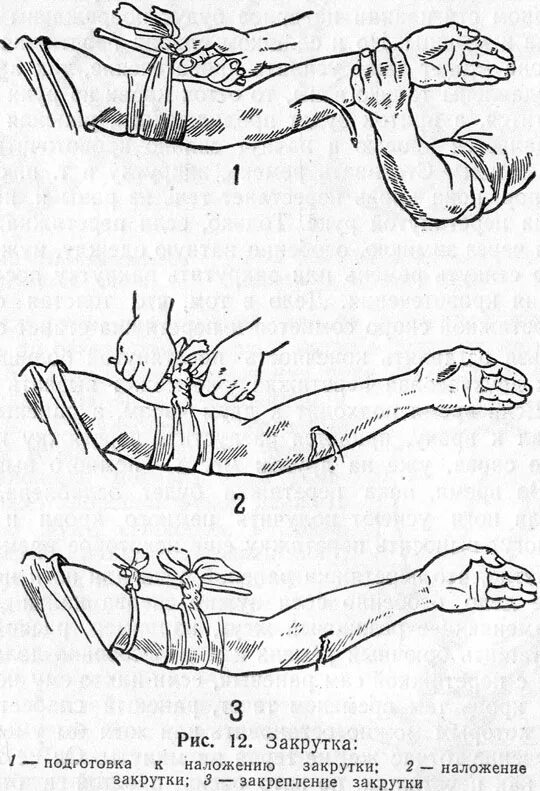 Наложение жгута закрутки. Перевязывание артериального кровотечения. Наложение повязки закрутка. Алгоритм наложения жгута. Как остановить кровотечение конечностей