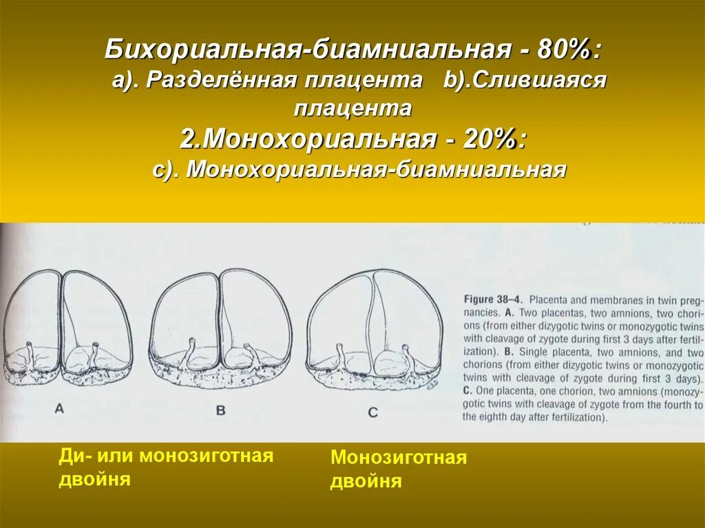 Что значит монохориальная двойня. Бихориальная-биамниальная плацента. двойня бихориальная монозиготная. бихориальная биамниотическая двойня. бихориальная биамниотическая беременность.