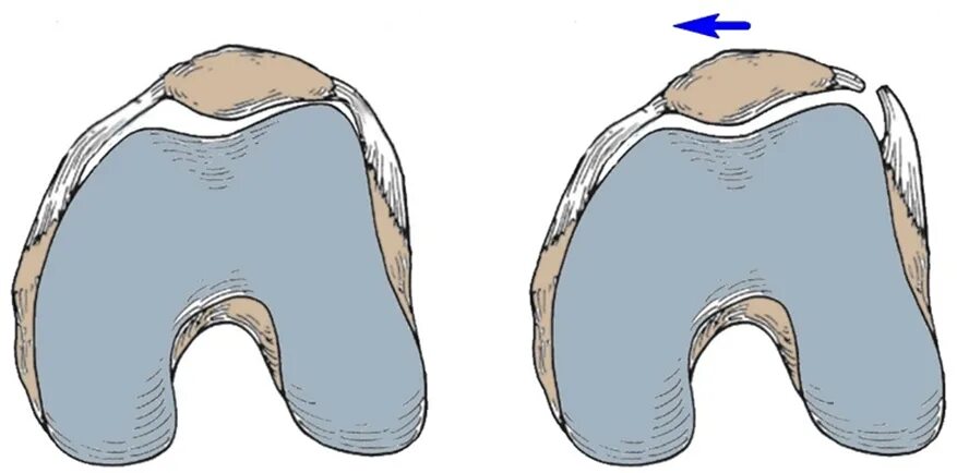 Латерализация надколенника. Латеральный вывих надколенника. Нестабильность надколенника дисплазия. Хроническая нестабильность надколенника. Хронический подвывих надколенника.
