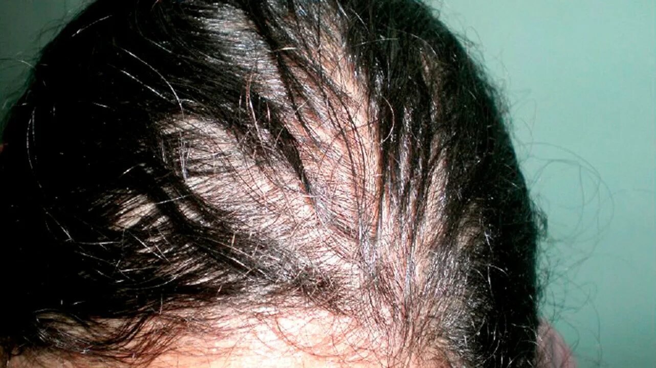 После коронавируса выпадают волосы. Выпадение волос алопеция.