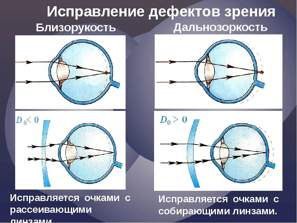 Оптическая линза назначение прибора. Дефекты зрения близорукость и дальнозоркость. Какими линзами корректируется близорукость и дальнозоркость. Коррекция линзами дефектов зрения. Линзы для коррекции миопии (близорукости).