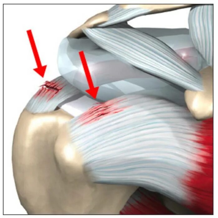 Лечение частичного разрыва мышц. Ротаторная манжета плечевого сустава анатомия. Вращательная манжета плечевого сустава мышцы. Разрыв сухожилия надостной мышцы. Тендинит сухожилия ротаторной манжеты плечевого сустава.