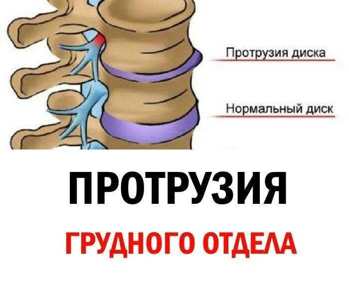 Протрузии межпозвонковых дисков поясничного отдела позвоночника. Протрузии межпозвонковых дисков грудного отдела. Протрузия диска позвоночника поясничного отдела. Протрузия диска шейного отдела позвоночника.