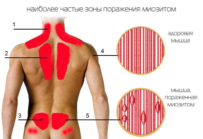 Болит позвоночник ниже лопаток. Воспаление мышц поясницы.