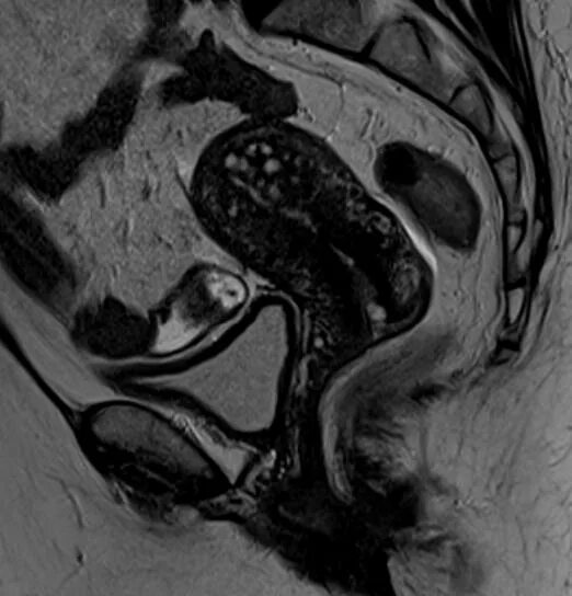 Очаговый аденомиоз мрт. Очаговый аденомиоз матки мрт. Аденомиоз на мрт малого таза. Ретроцервикальный эндометриоз мрт. Мрт эндометрия