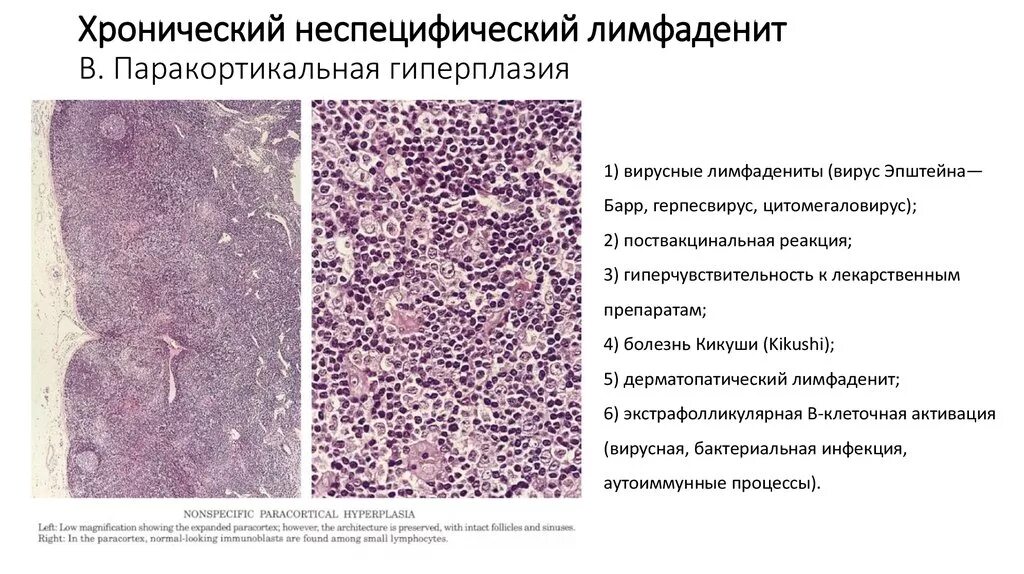 Лимфоузлы гиперплазированы. Неспецифический лимфаденит гистология. Гиперплазия лимфатического узла микропрепарат. Гиперплазия лимфатического узла гистология. Неспецифический лимфаденит патологическая анатомия.