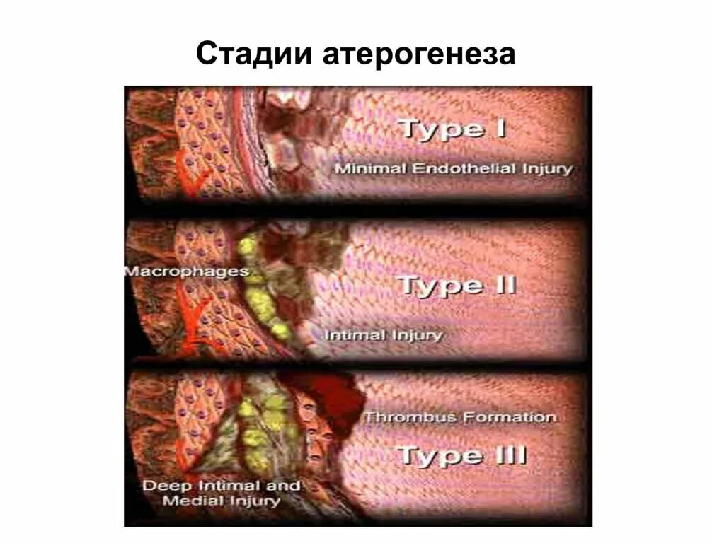 Стадии атеросклероза артерий
