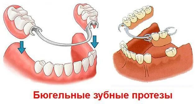 Как крепят зубы
