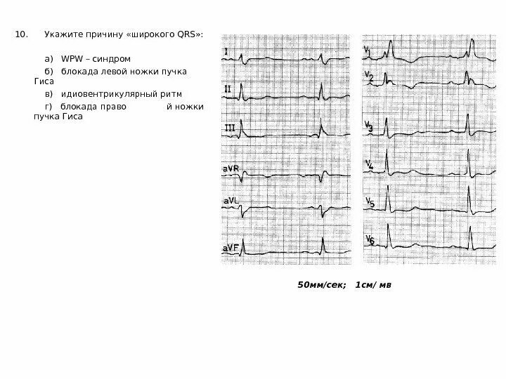 Блокада ножки гиса причины. Wpw + полная блокада левой ножки. Блокада правой ножки пучка и wpw. Синдромы при.блокаде.левой ножки пучка Гиса. Wpw синдром с блокадой левой ножки пучка Гиса.