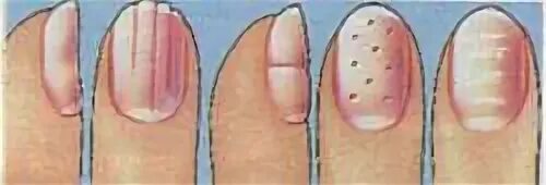 Белая продольная полоса на ногте. Поперечные белые полоски на ногтях. Горизонтальные полосы на ногтях рук.