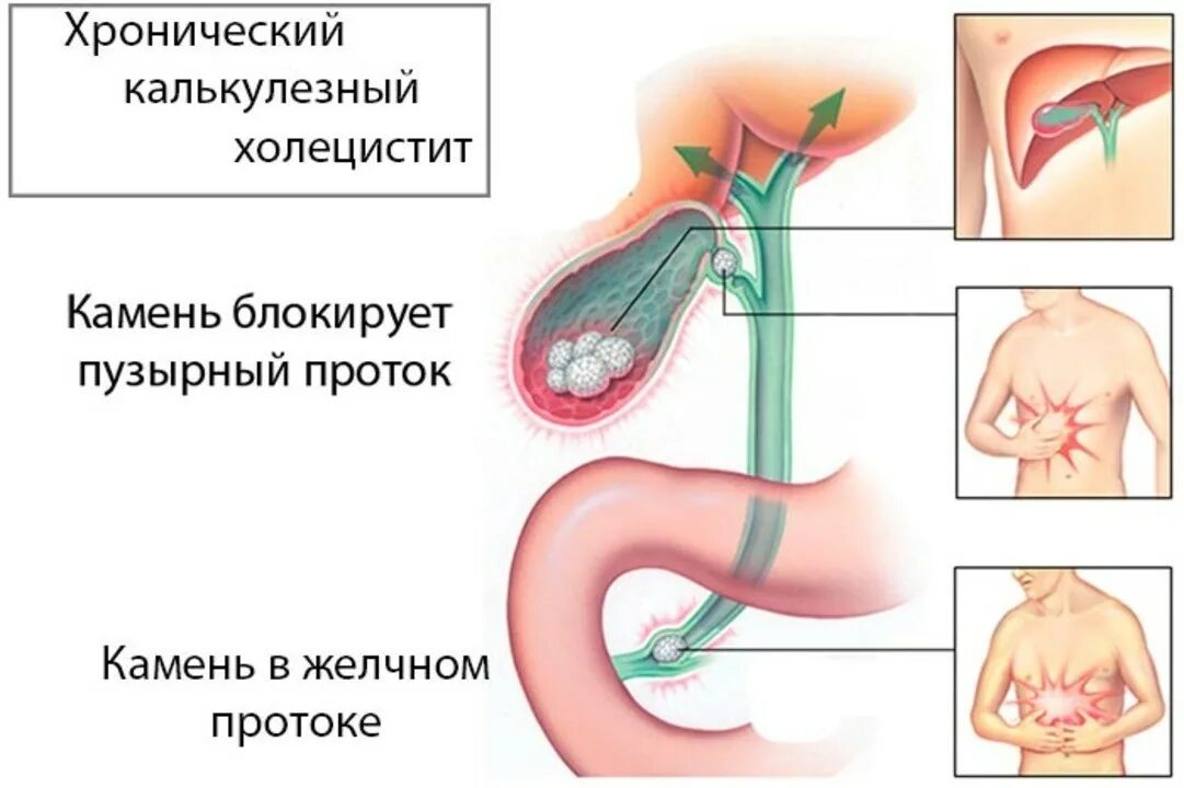 Тошнота при холецистите. ЖКБ хронический калькулезный холецистит. Хронический калькулезный холецистит синдромы. Хронический холецистопанкреатит симптомы. ЖКБ хронический калькулезный холецистит симптомы.