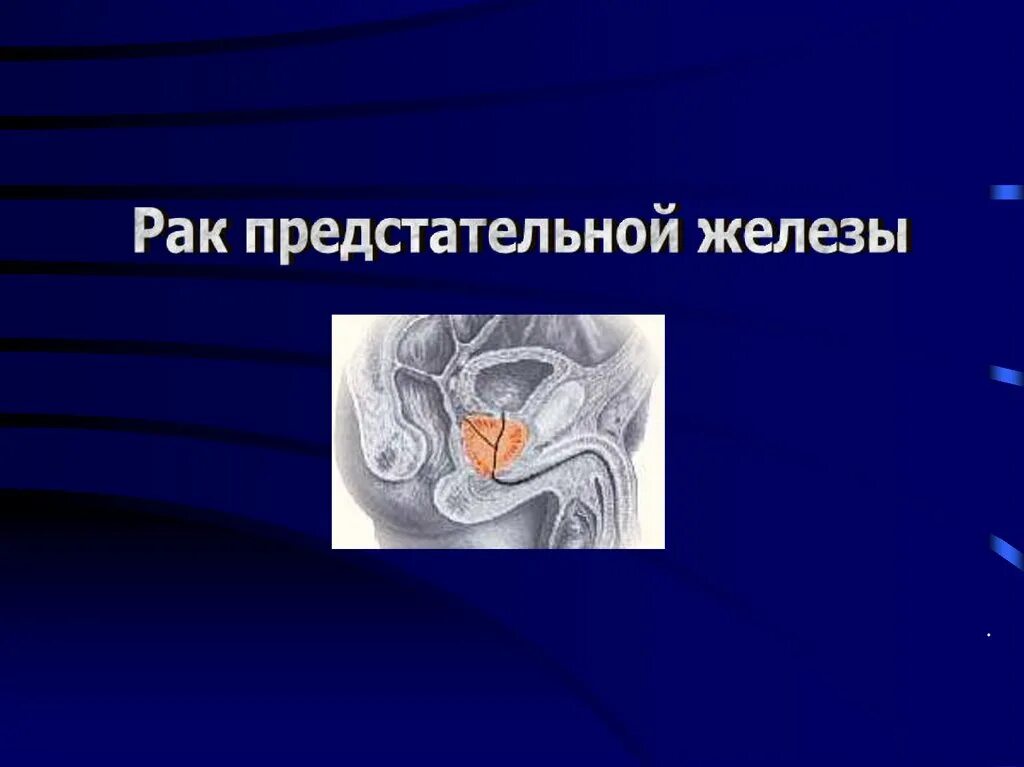 Девочки простата. Предстательная железа для презентации. Презентация онкология предстательной. Красота в простате простата.