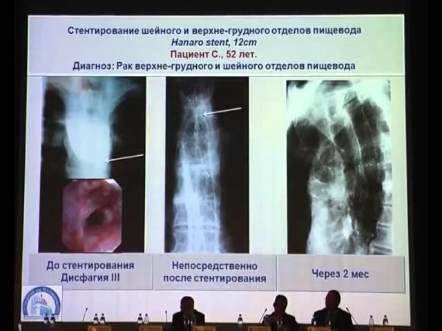 Синяк после стентирования. Стентирование пищевода. стентирование пищевода осложнения. стентирование желудка. протокол стентирования пищевода.