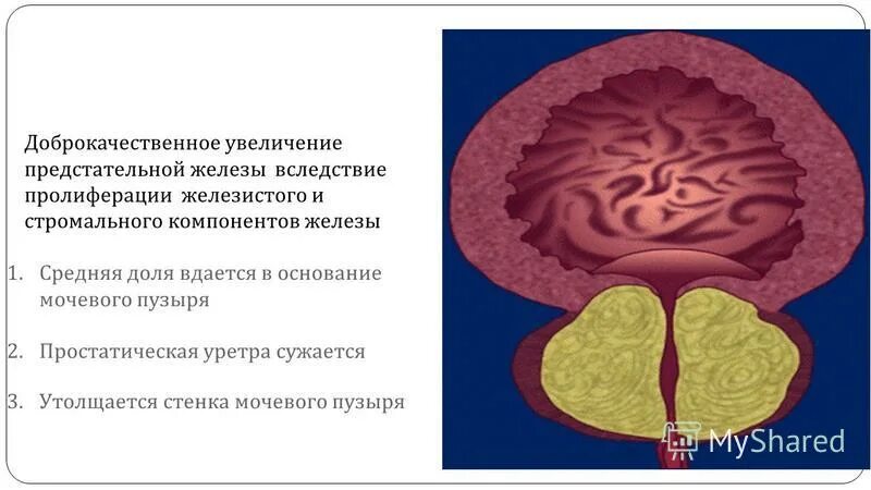 Железистая гиперплазия предстательной железы. Доли предстательной железы. Увеличение средней доли предстательной.