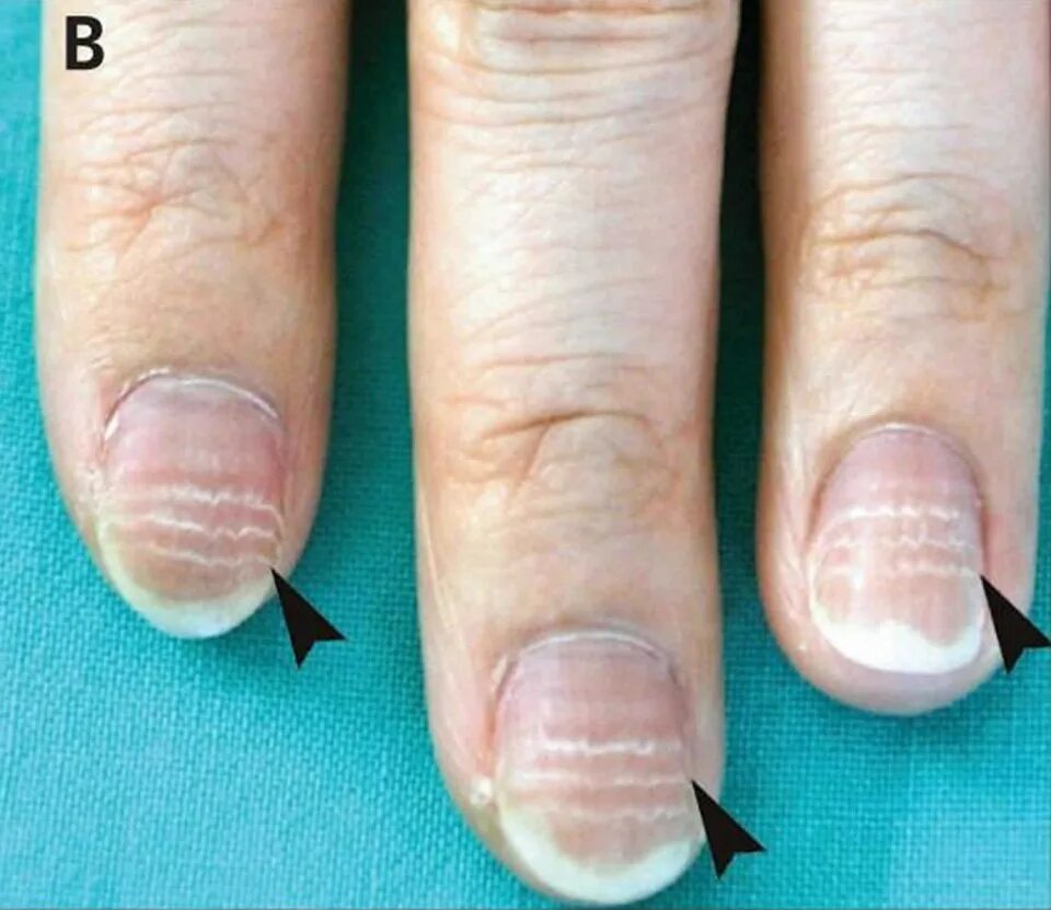 Онихорексис, ониходистрофия. Ногти поперечные борозды бо (линии бо-Рейля). Ониходистрофия (дистрофия ногтей). Ониходистрофия поперечные борозды.