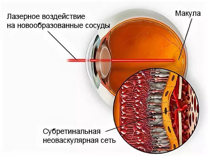 Лечение дегенерации макулы. Дегенерация желтого пятна макулы. Макулярный рефлекс сетчатки calur. Рост новообразованных сосудов макулы.