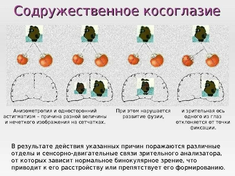 Анизометропия это в офтальмологии. Анизометропия. Болезнь глаз анизометропия. Анизометропия глаза у детей.