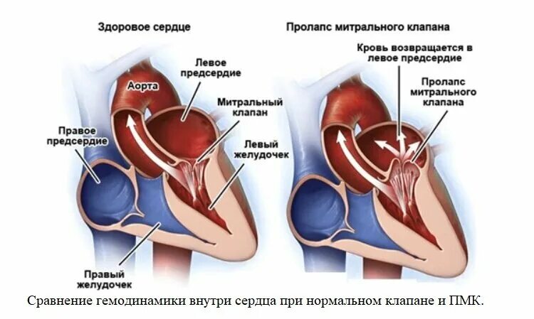 Что такое пролапс митрального клапана. Пролапс нейтрального клапана сердца 1 степени. Пролаз передней створки митрального клапана. Пролабирование створок митрального клапана 1. Диагноз:i34.1 пролапс пролабирование митрального клапана.