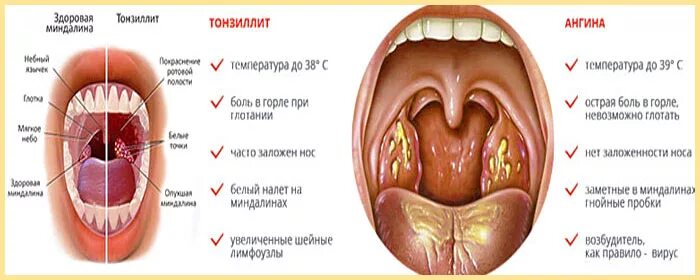Сильная боль при глотании с температурой. Небные миндалины тонзиллит. Хронический тонзиллит налет.
