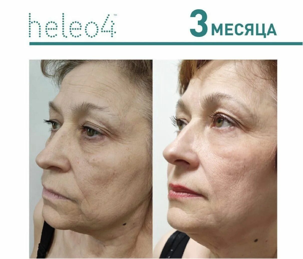 Микротоки лицо до и после фото отзывы. Фдт heleo4. микротоки для лица lj b gjckt. фотодинамическая терапия heleo.