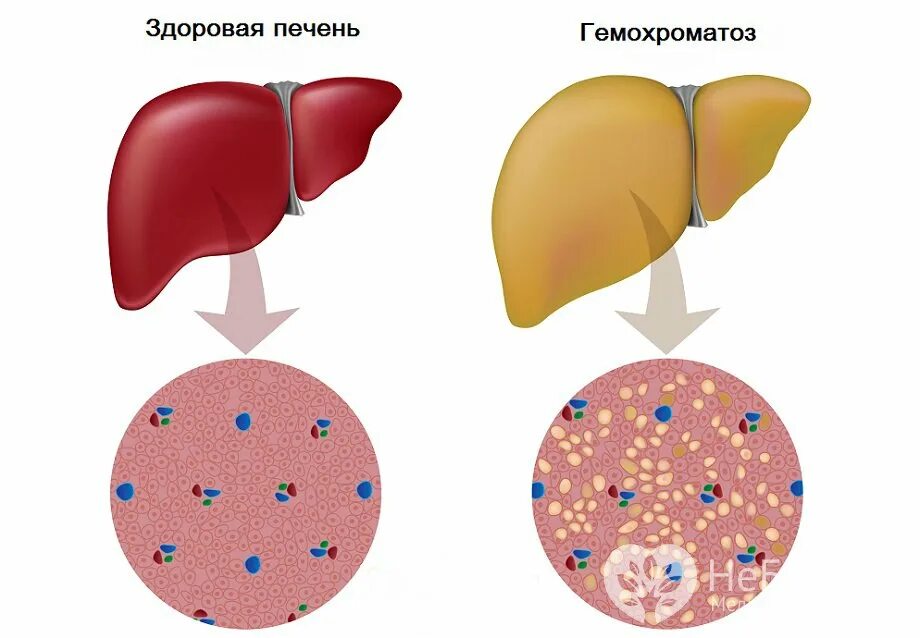 Идиопатический гемохроматоз. Гемохроматоз печени симптомы. Наследственный гемохроматоз печень. Гемохроматоз наследственное заболевание. Повышен железа печень