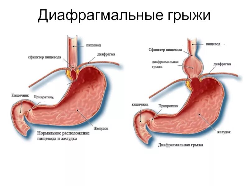 Клапан между желудком и пищеводом. Хиатальная грыжа пищеводного отверстия. Врожденная ложная диафрагмальная грыжа. Диафрагмальная эзофагеальная грыжа. Диафрагмальные грыжи схема.