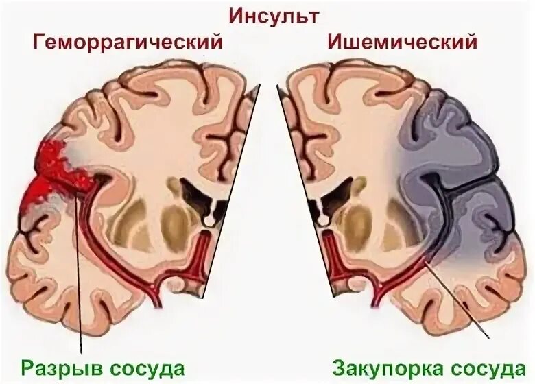 Инсульт различия. Ишемический и геморрагический инсульт разница. Типы ишемического инсульта. Геморрагический инсульт от ишемического.
