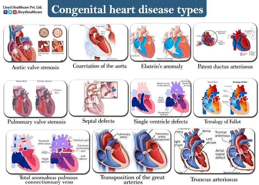 Congenital heart disease. Congenital heart disease classification. Congenital heart disease. Congenital heart disease. Дефект межжелудочной перегородки сердца.