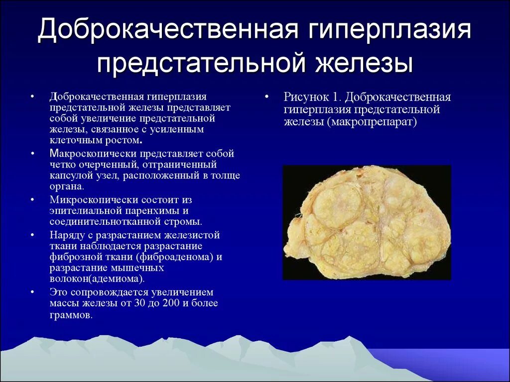 Доброкачественной гиперплазией предстательной железы у мужчин. Макро гиперплазия простаты. Доброкачественная гиперплазия предстательной железы макропрепарат. Узловая аденоматозная гиперплазия предстательной железы. Гипоплазия престатильной железы.