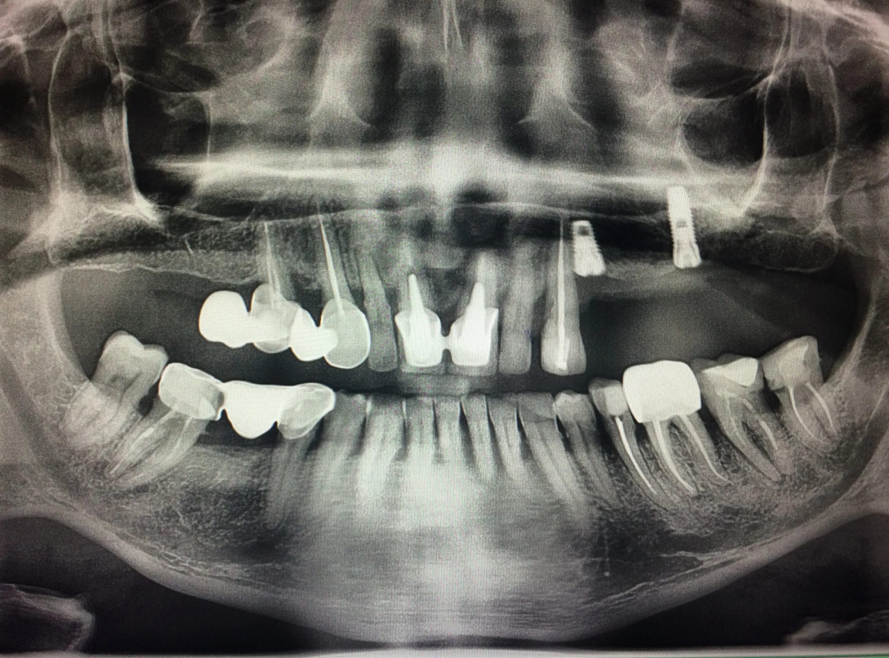 Рентген ортопантомограмма зубов. ОПТГ зубных рядов Пикассо. ОПТГ ортопантомограмма норма. Ортопантомограмма челюсти.