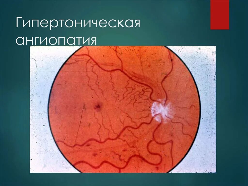Ангиопатия сетчатки глазное дно. Гипертоническая ретинопатия глазное дно. Ангиоретинопатия сетчатки. Гипертоническая ангиопатия сетчатки.