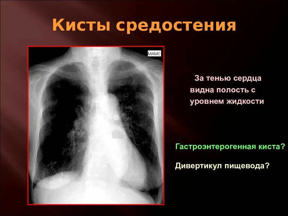 Киста пищевода. Целомические кисты средостения. Киста средостения рентген. Дермоидная киста средостения кт.