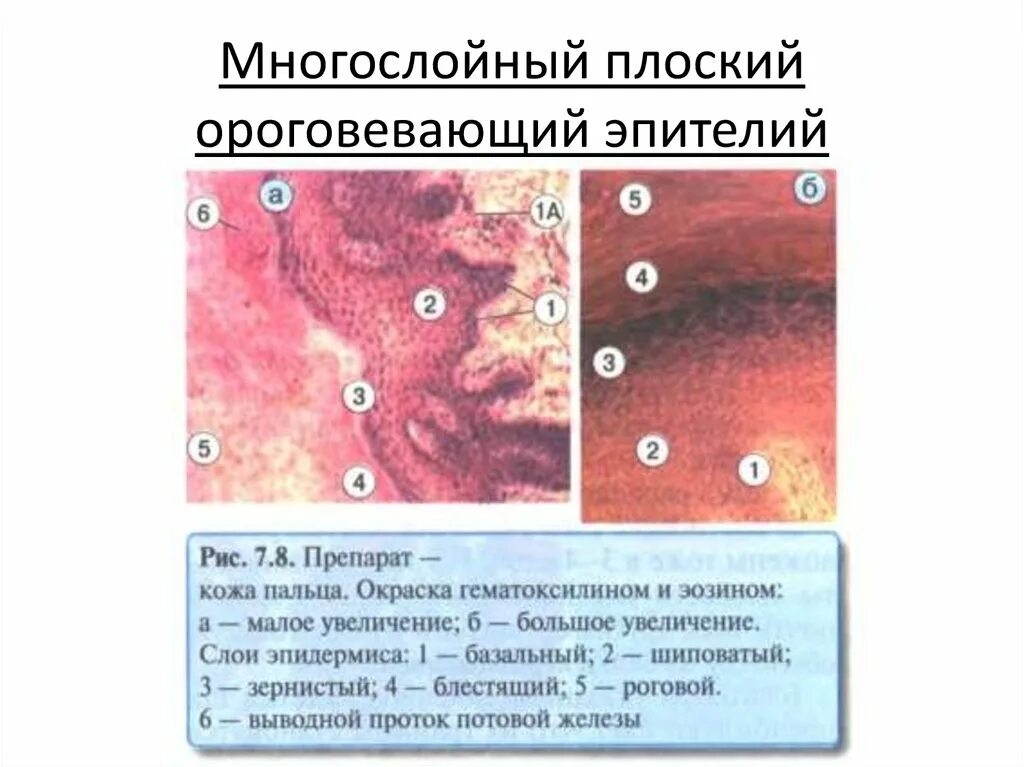 Плоское интраэпителиальное поражение низкой степени. Шейка матки ацетобелый эпителий. Многослойный плоский эпителий шейки матки. Йод негативный эпителий. Многослойный плоский ороговевающий эпителий пальца.