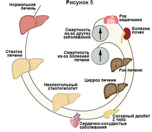 Жировая печень что пить. Неалкогольная жировая болезнь печени стадии. Фокальный жировой гепатоз печени кт. Неалкогольный стеатоз печени. Стадии стеатоза печени.