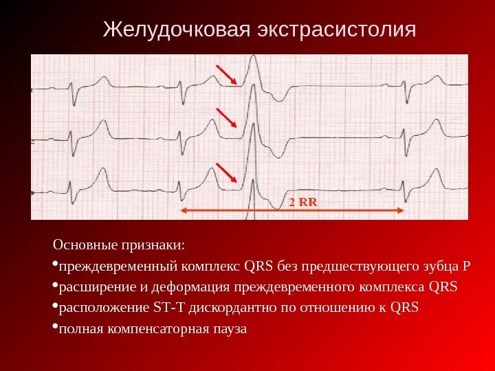 Деформированный зубец р