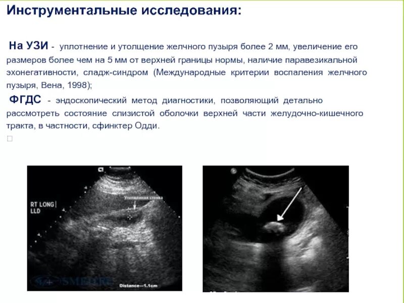 Паравезикальная клетчатка. Сладж-синдром желчного пузыря на УЗИ протокол. Эмпиема желчного пузыря на УЗИ протокол. Билиарный сладж по УЗИ.