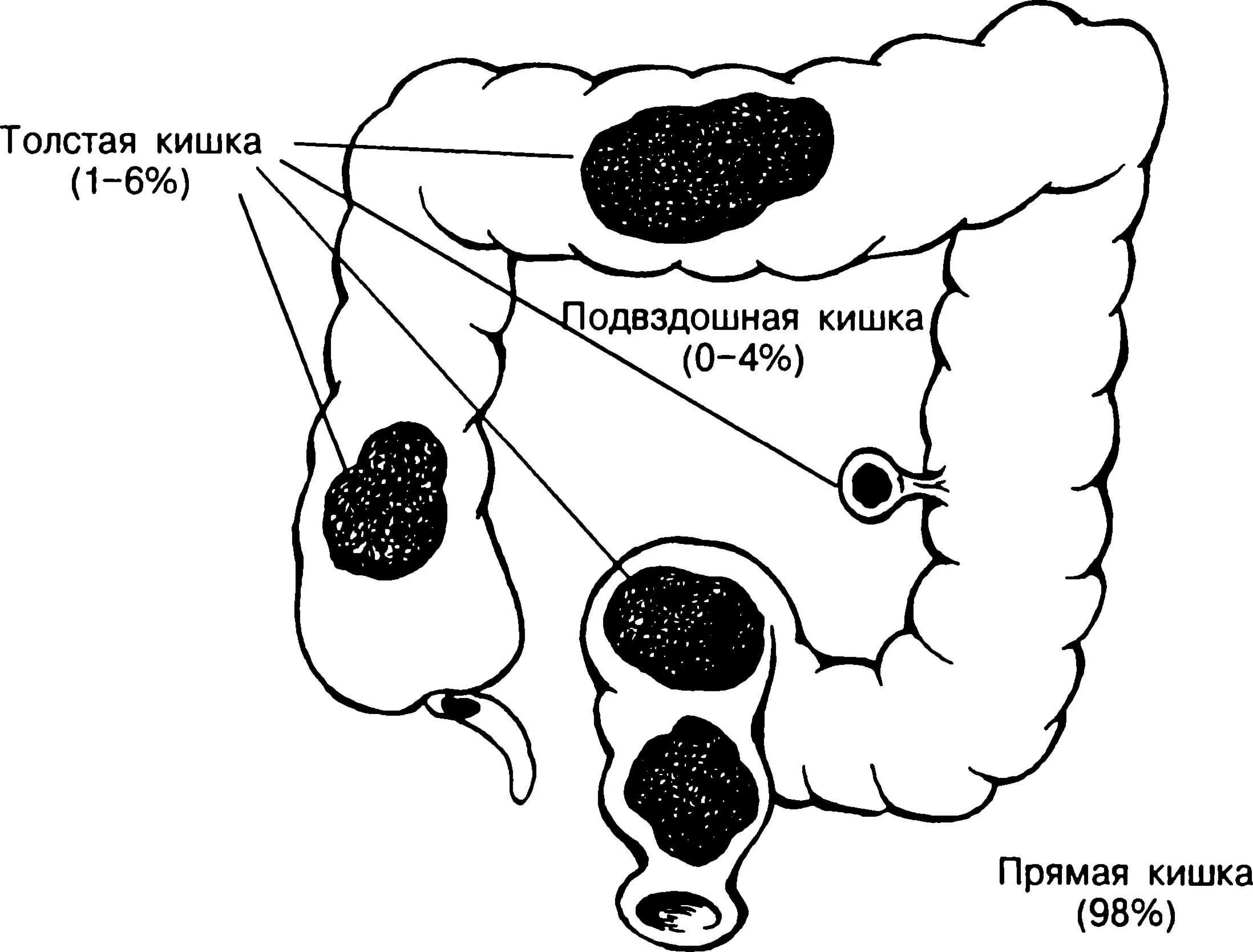 Как очистить кишечник от камней. Каловые камни Толстого кишечника. Каловые массы в кишечнике схема. Каловые массы в кишечнике камни. Каловые камни в толстой кишке симптомы.