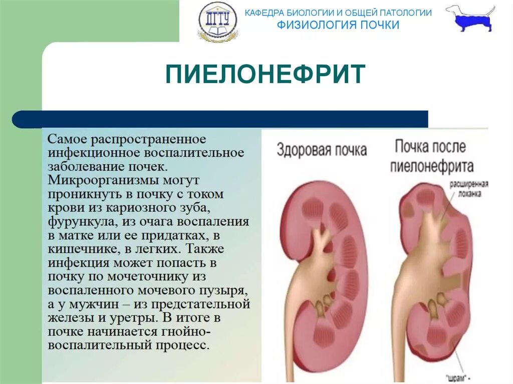 Что может привести к инфекционному заболеванию почек. Воспаление почек пиелонефрит. Патология почки. Пиелонефрит. Болезнь с почками полинефрит. Хронический пиелонефрит поражение почек.