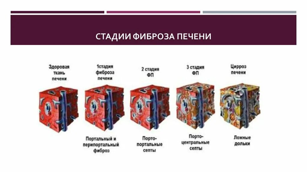 Степени фиброза печени при гепатите с f2.